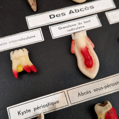 Ancien tableau pédagogique des maladies dentaires, dents en relief